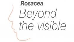 Galderma Global Study Reveals True Burden Of Rosacea and Encourages Healthcare Professionals To Look ‘Beyond the Visible’